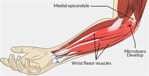 Bench Press And Medial Epicondylitis Pronator Teres - Tft Decoration Gallery