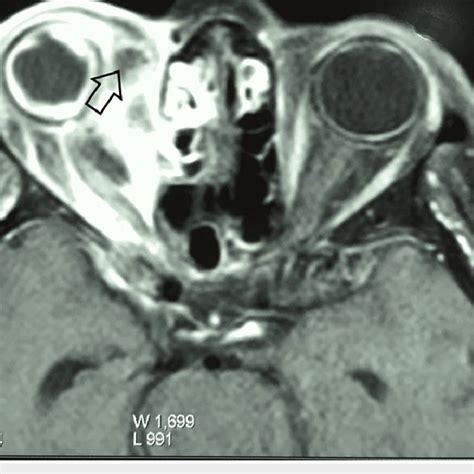 Magnetic resonance imaging of the brain and paranasal sinuses showing... | Download Scientific ...