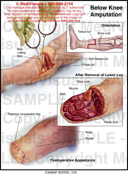 Below Knee Amputation Anatomy