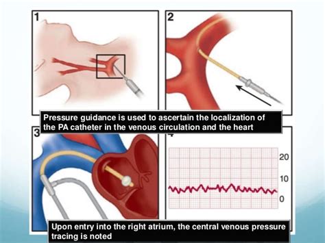 Pulmonary Artery Wedge Pressure