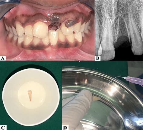 Replantation of an Avulsed Tooth: A Case Report | Cureus