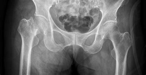 Subcapital Left Femoral Neck Fracture