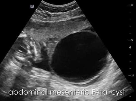 CASE 701 abdominal mesenteric Fetal cyst 3D 4D - YouTube