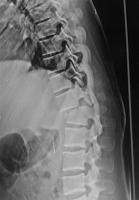 Thoracolumbar Fracture-Dislocation - Spine - Orthobullets