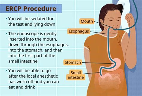 ERCP Procedure: Digestion Diagnosis, Treatment, Results