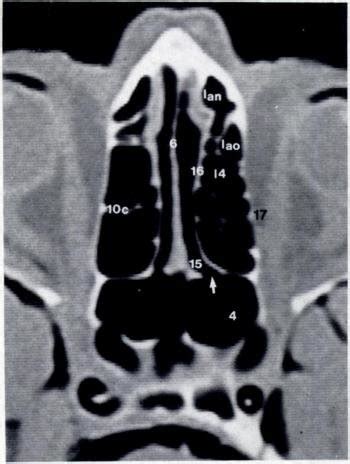 General CT anatomy of ethmoid with landmarks. A, Anterior coronal scan.... | Download Scientific ...