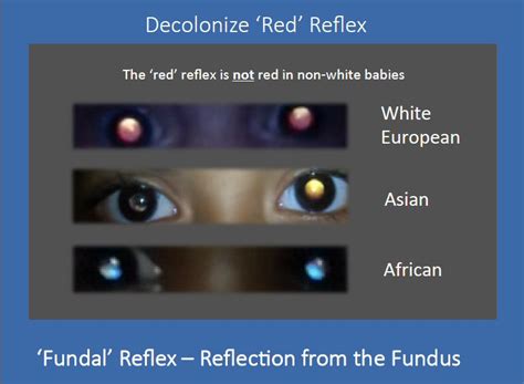 Fundal (Red Eye) Reflex and Red-Eye Reduction - WE C Hope