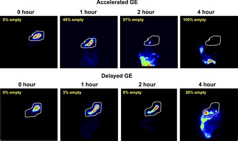 Gastric Emptying - Clinical Gastroenterology and Hepatology