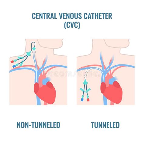 Central Line Venous Catheter Types on Male Body Stock Vector ...