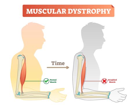 Muscular Dystrophy – Mitchell McConnell AEP – Vision Health