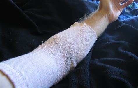 Sock Arm Bandage : 6 Steps - Instructables