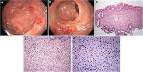 Symptoms of malakoplakia - MEDizzy