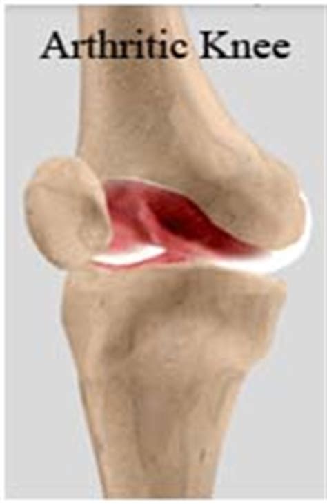 India Surgery Unicondylar Knee Replacement Mumbai,India Knee Mumbai