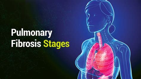 Lung Health Institute | Pulmonary Fibrosis Stages | Pulmonary fibrosis ...