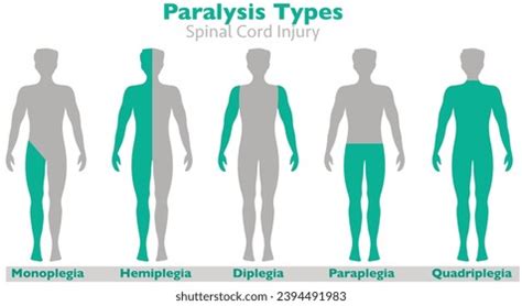 Paralysis Types Spinal Cord Injury Hemiplegia Stock Vector (Royalty Free) 2394491983 | Shutterstock