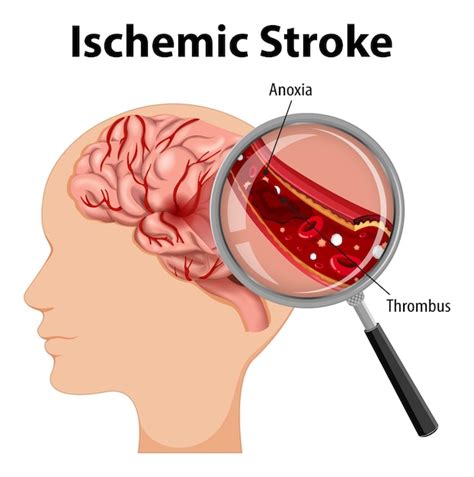 Free Vector | Human with Ischemic stroke