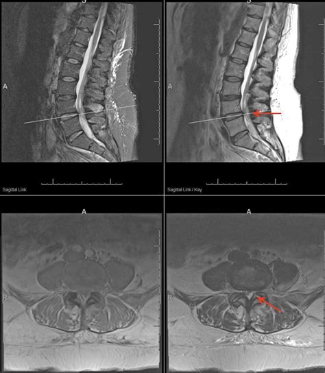 Lumbar Facet Joint Arthritis