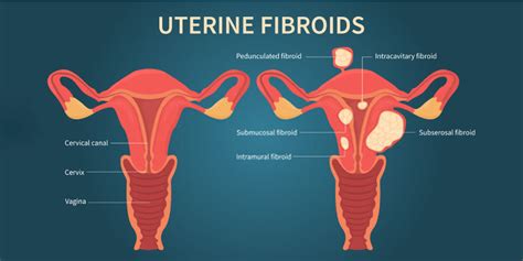 Swollen Uterus