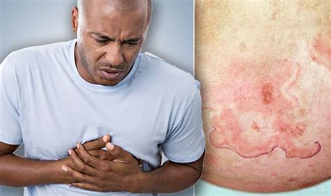 Heart attack symptoms: Signs of heart disease include rash on your skin - common symptoms ...