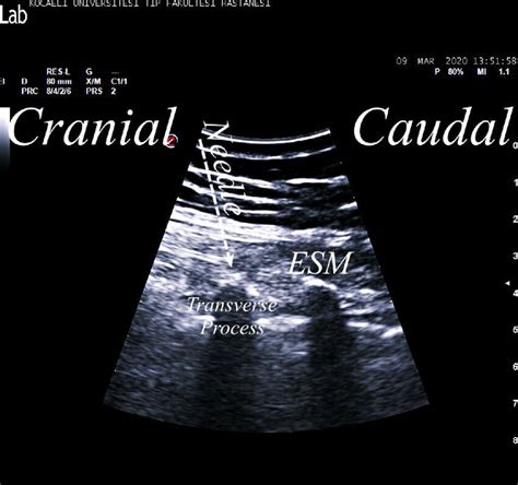 Ultrasound image of erector spinae plane block. ESM, erector spinae ...