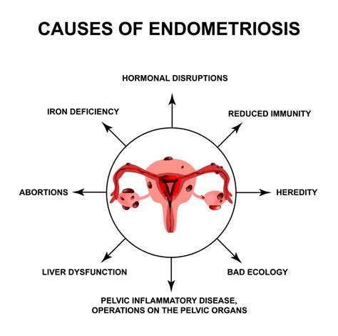 Endometriosis And Its Treatment