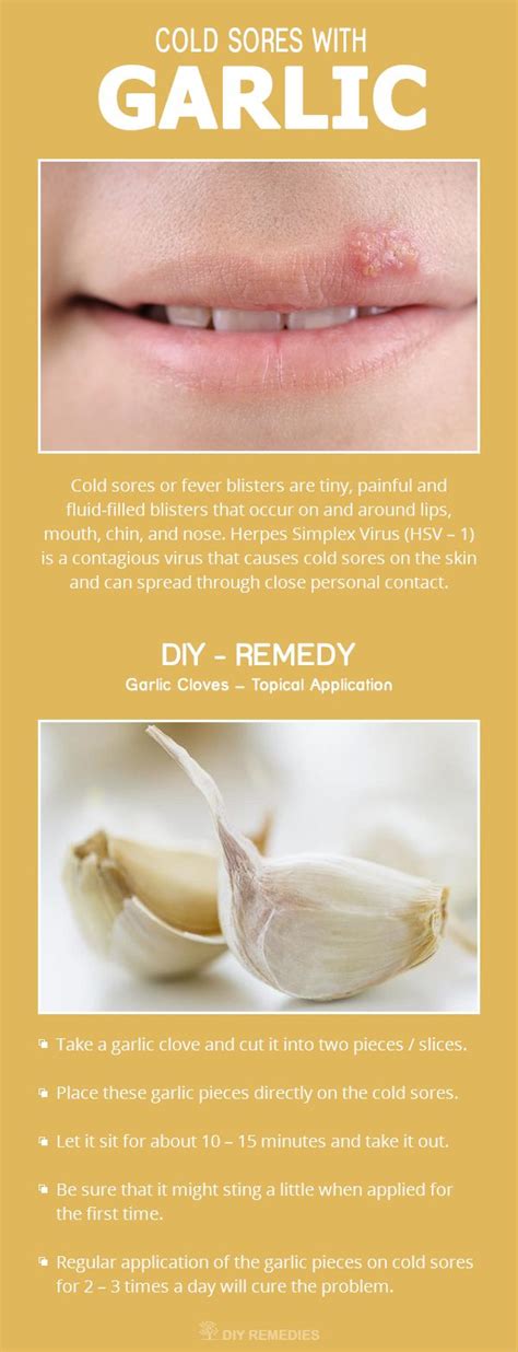 Get Rid of Cold Sores with Garlic | Cold sore, Remedies, Cold sores ...