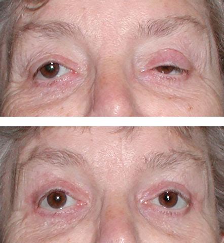 Ptosis Repair: Before and After - Eyelid & Facial Aesthetics