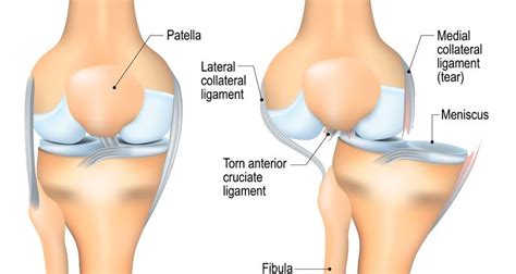 Dislocated Knee - Symptoms, Causes & Treatment