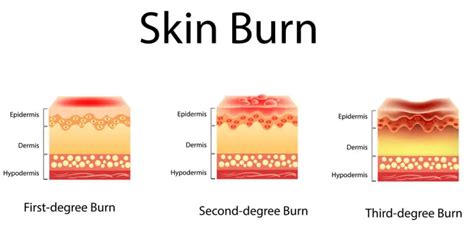 The Classification of Burns – Free CPR Training