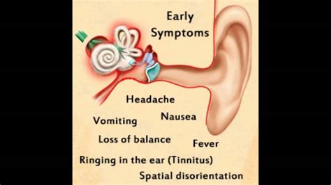 Inner Ear Infection Symptoms - YouTube