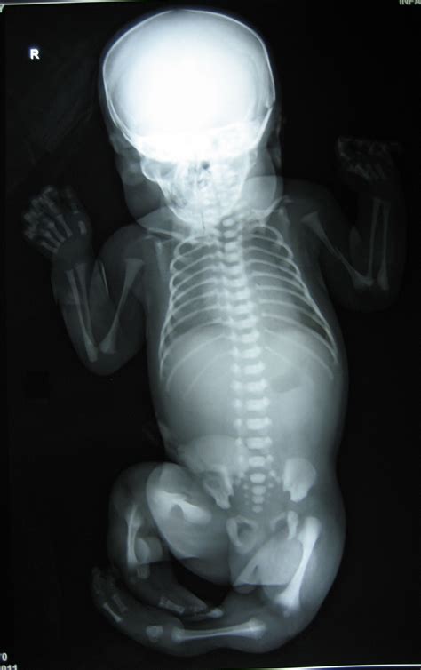 OSTEOPETROSIS WITH BIRTH TRAUMA - Dr. Vasu