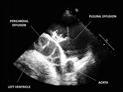 Pericardiocentesis From Back Under Echographic Guidance | Circulation