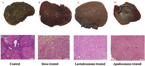 Treatment of hepatocellular carcinoma. Hepatocellular carcinoma was... | Download Scientific Diagram