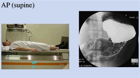 Procedure of upper gi