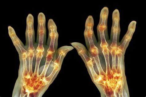 5 Easy Ways to Help You Manage Hand Osteoarthritis… | Tristate Arthritis & Rheumatology