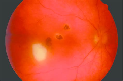 recurrent toxoplasma retinochoroiditis. A 'satellite lesion' associated ...