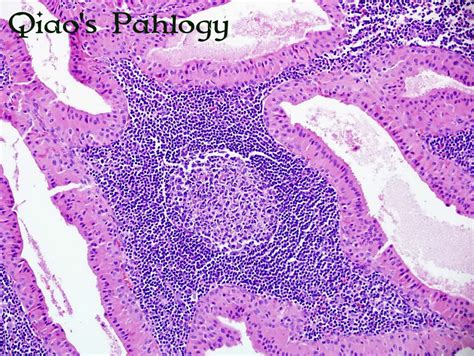 Qiao's Pathology: Warthin's Tumor of Parotid Gland - a photo on Flickriver