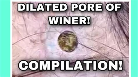 Dilated Pore Of Winer Extraction COMPILATION! END OF 2020! - YouTube