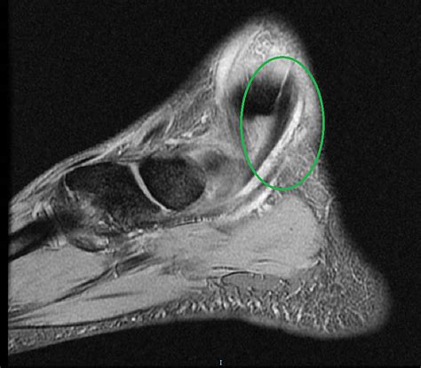 Posterior Tibial Tendonitis Mri | Porn Sex Picture