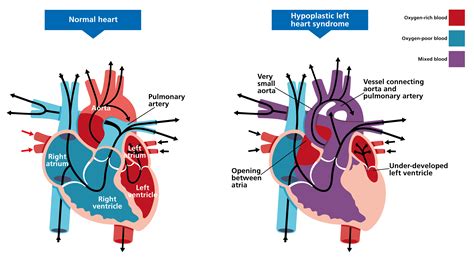 Hypoplastic left heart syndrome — Knowledge Hub