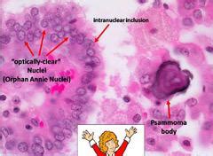 Papillary Carcinoma Thyroid Psammoma Bodies