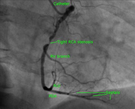 Proximal right coronary artery stenosis – All About Cardiovascular ...