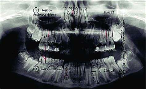 Placing the plot on the orthopantomogram. | Download Scientific Diagram