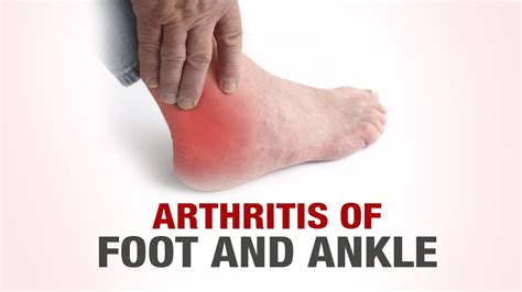 Arthritis of foot and ankle-Dr. Gaurav Sharma-Defeating Arthritis - YouTube