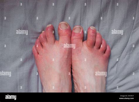 Feet of person with erythromelalgia, erythromelalgia symptoms flare ...