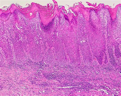 Proliferative Verrucous Leukoplakia Histology