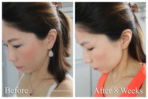 Ultherapy Results: Before & After Photos show slimmer face and sharper under-chin ...