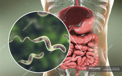 Human intestine and close-up of Campylobacter jejuni bacteria causing ...