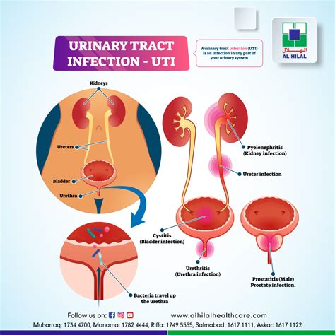 Urinary Tract Infection (UTI)