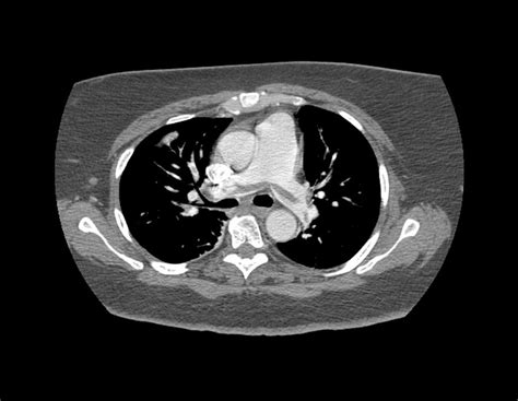 Pulmonary Embolism, Ct Scan #2 by Du Cane Medical Imaging Ltd